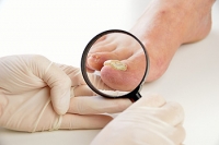 How to Treat Fungus on Your Toes
