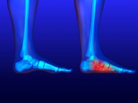 Low Muscle Tone in the Feet May Be Related to Flat Feet